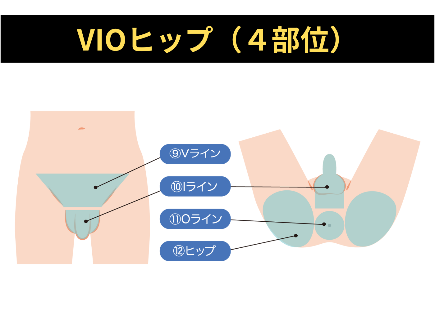 VIOH4部位